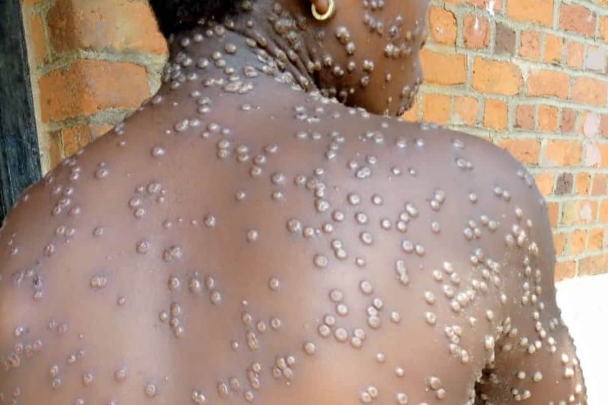 Et si la variole du singe mpox arrivait à La Réunion