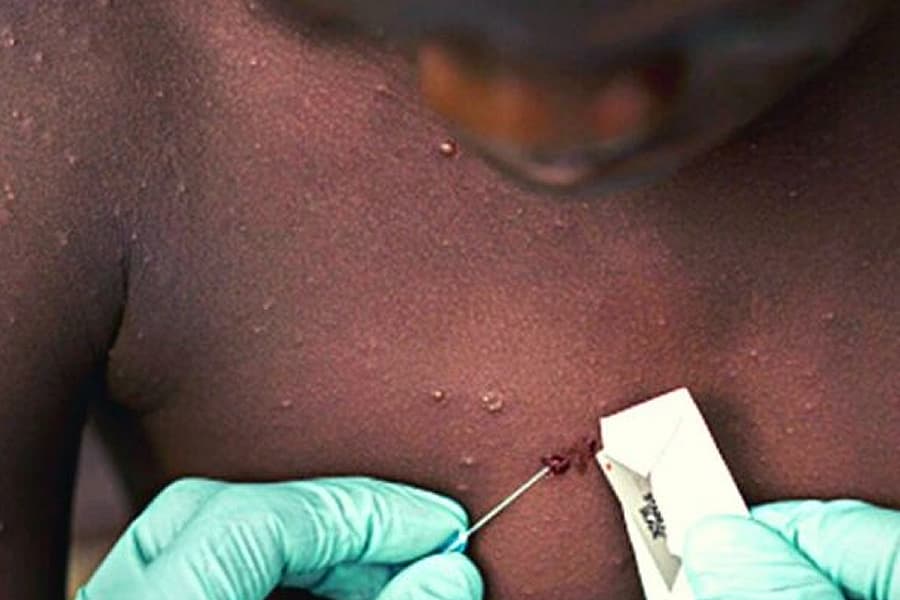Monkeypox : doit-on craindre la variole du singe à La Réunion ?