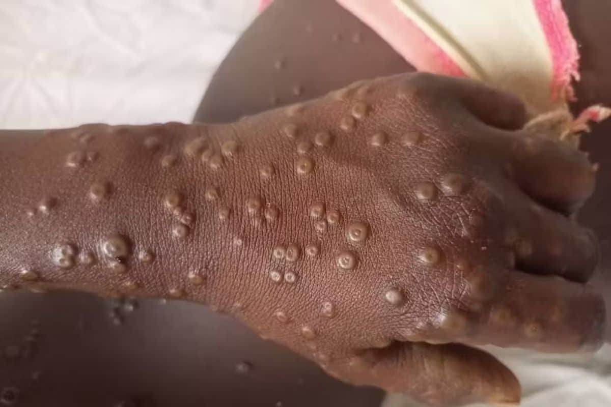 mpox