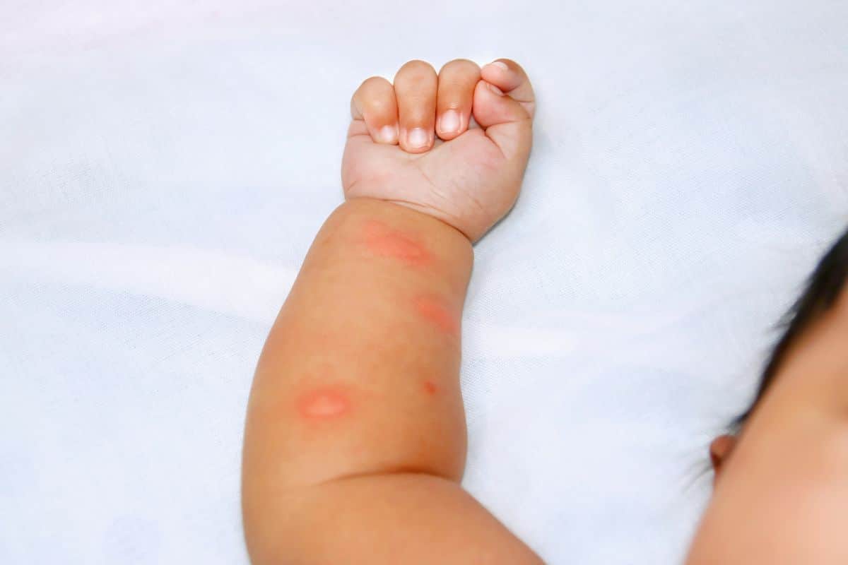 Sept nouveau-nés hospitalisés après une aggravation de l'épidémie de chikungunya