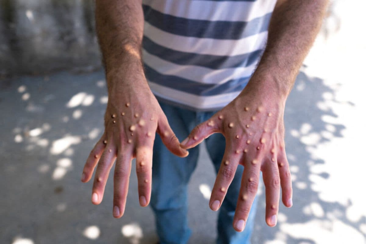 Le virus qui peut circuler en ce début d’année l'alerte Mpox à Madagascar