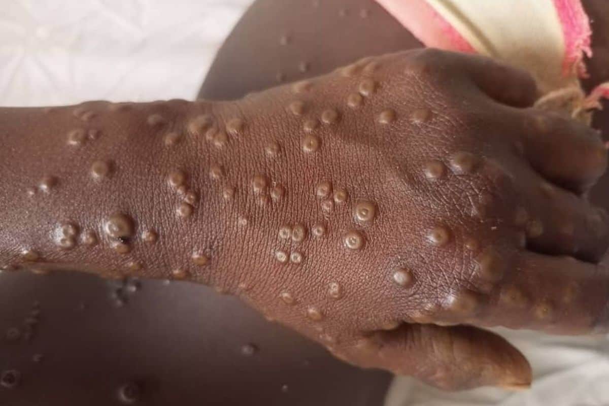 Mpox à La Réunion un premier cas confirmé, les autorités en alerted’un sapeur-pompier à La Possession le préfet dénonce une violence inacceptable